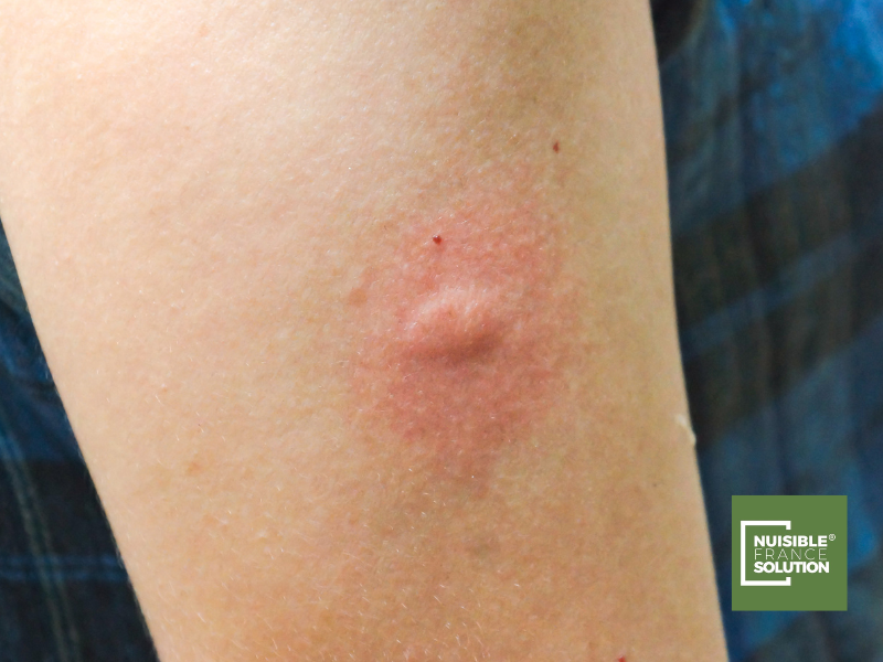 Piqûres de moustiques ou de punaises de lit ? Les différences expliquées par un professionnel